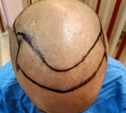 Balding male patient in his 30s with markings on his shaved scalp for the preparation of the FUE hair transplant procedure being done by Dr. Poonam Arya