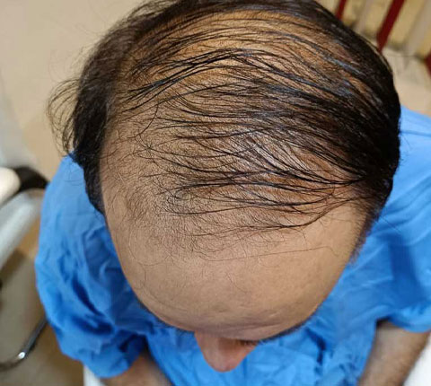 Top down view of a balding male patient's head, displaying thin hair and bald areas on his scalp