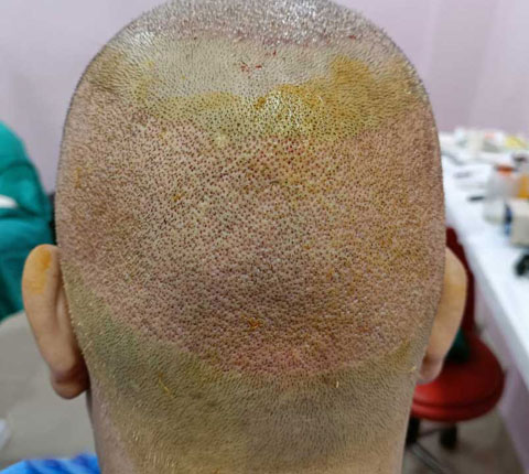 Back view of a patient who just underwent FUE hair transplant procedure done by Dr. Poonam Arya, displaying areas from where donor hair was taken