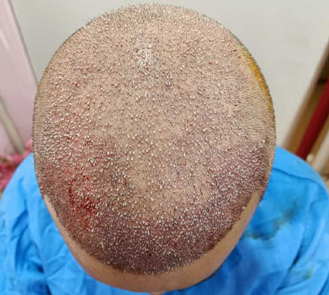 Top down view of the scalp of man who just underwent FUE hair transplant procedure done by Dr. Poonam Arya, displayings areas where donor hair has been grafted