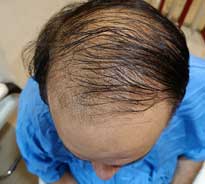 Top down view of a balding male patient's head, displaying thin hair and bald areas on his scalp