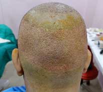 Back view of a patient who just underwent FUE hair transplant procedure done by Dr. Poonam Arya, displaying areas from where donor hair was taken