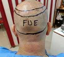Back view of a patient's head who is about to undergo FUE hair transplant procedure by Dr. Poonam Arya, displaying areas from where donor hair will be taken with the help of markings