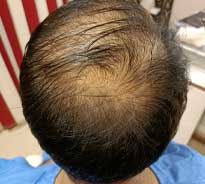 Back view of a balding male patient's head