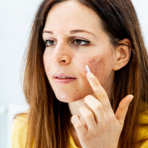 image of the Acne treatment